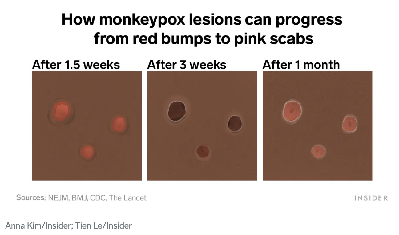 Pictures show how monkeypox lesions and rashes really look on different skin tones and body parts, and how they change over time